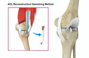 ACL Reconstruction of Hamstring Tendon