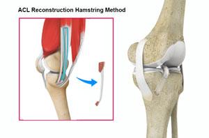 ACL Reconstruction Procedure of Hamstring Tendon