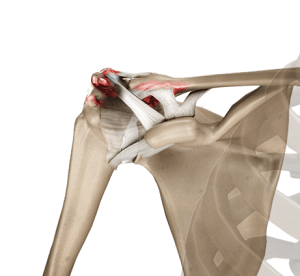 Acromioclavicular Joint (AC) Joint Reconstruction