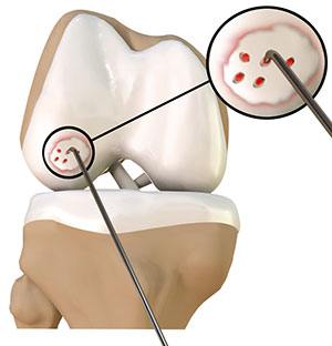 Chondroplasty