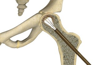 Core Decompression for Avascular Necrosis of the Hip