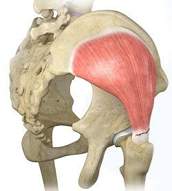 Hip Bursitis - Ortho Illinois