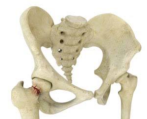 Hip Fracture ORIF