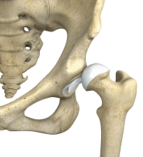 Hip Groin Disorders