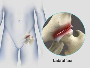 Hip Labral Repair