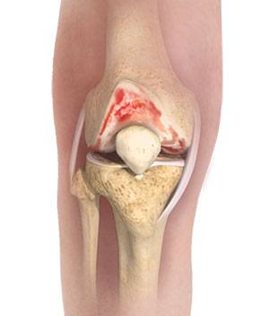 Knee Osteoarthritis