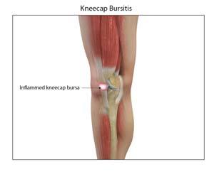 What is 2025 kneecapping