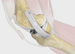 Medial Collateral Ligament Reconstruction Video