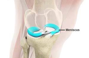 Meniscal Transplantation