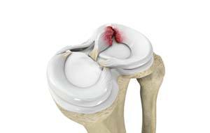 Meniscal Tears