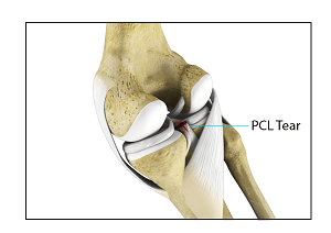 PCL Reconstruction