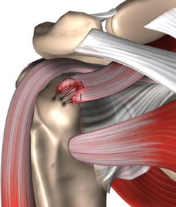 Rotator Cuff Injury Treatment in Langley - DIVINE CARE